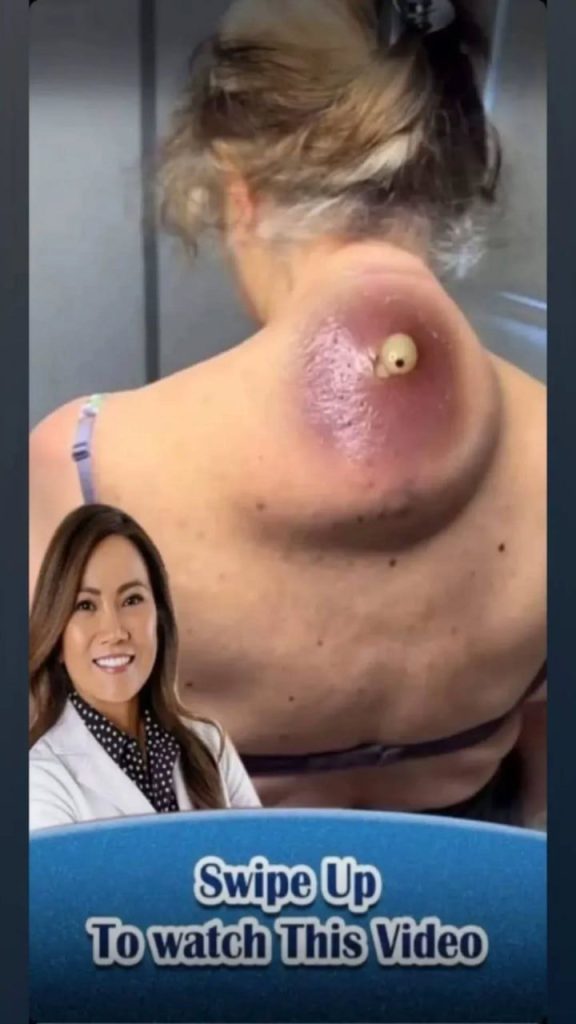 How to Care for and Protect Big Acne (Cysts) on the Neck 🧴🧼💆‍♀️